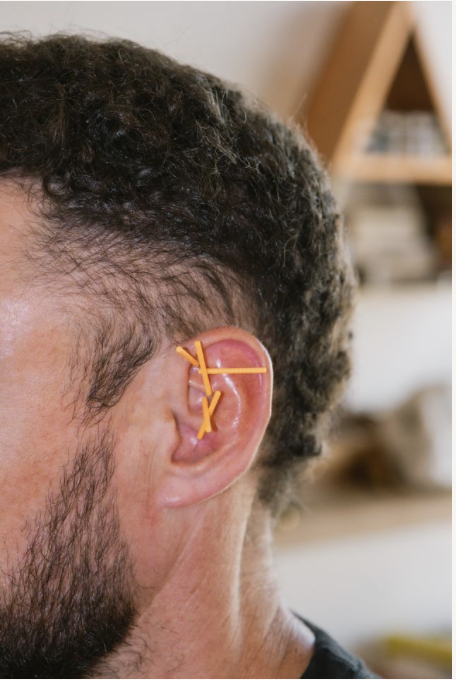 NADA ear acupuncture
